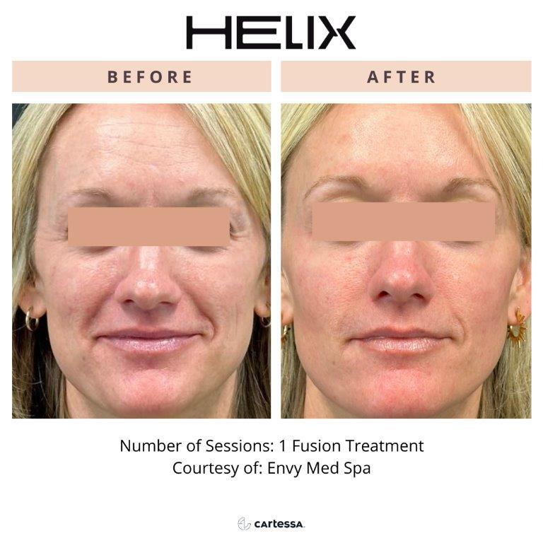CoolPeel Before & After Image