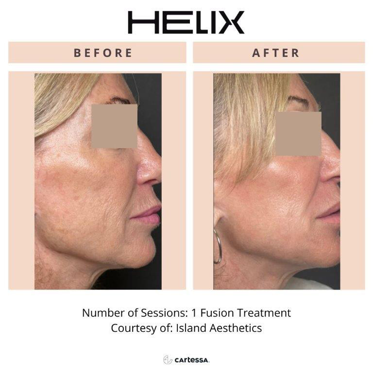 CoolPeel Before & After Image
