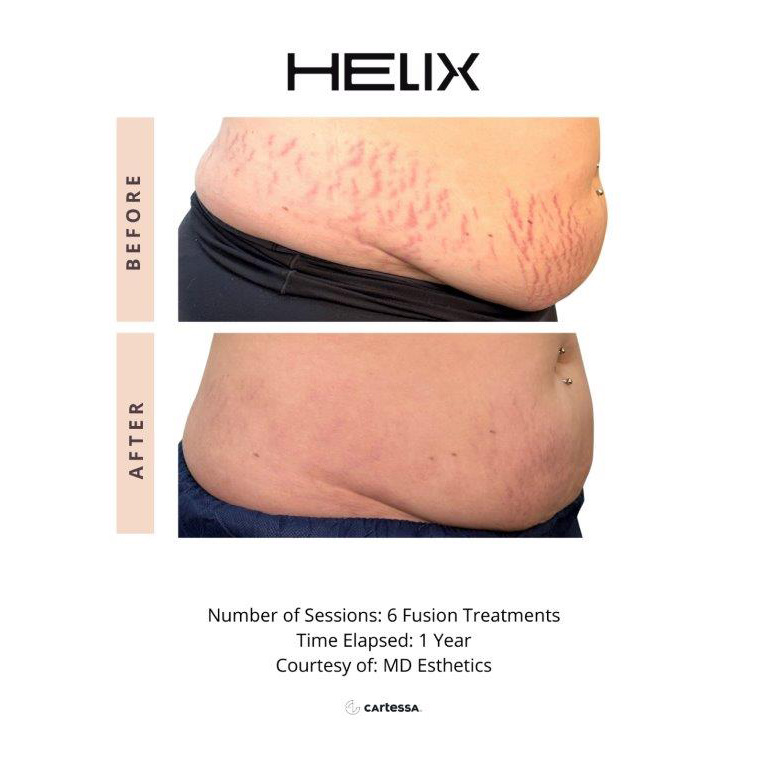 CoolPeel Before & After Image