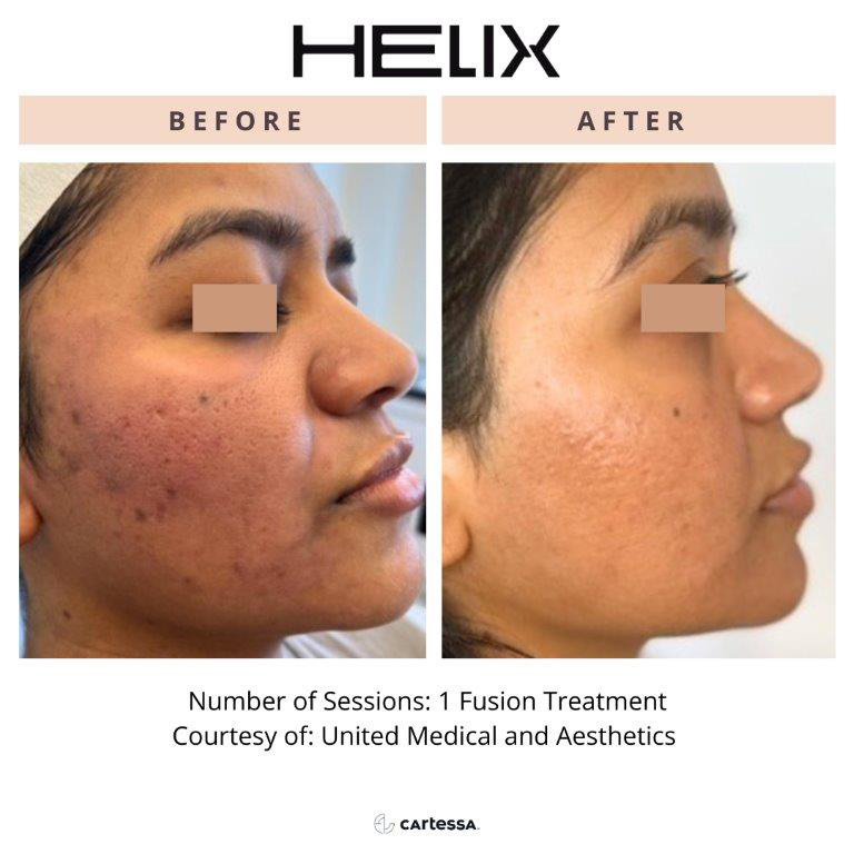 CoolPeel Before & After Image