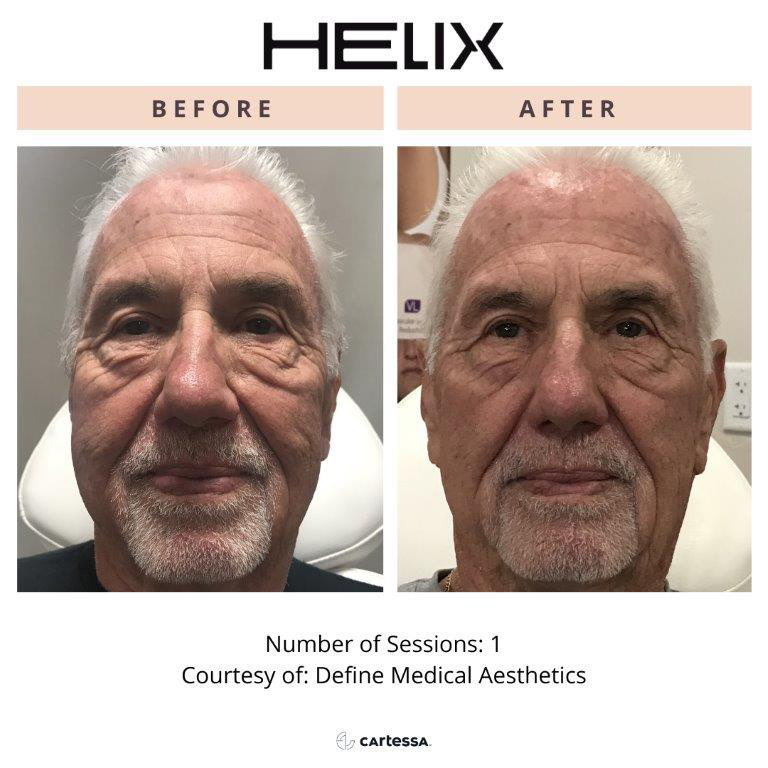 CoolPeel Before & After Image