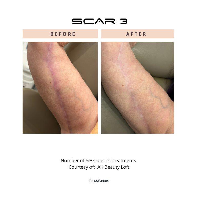 CoolPeel Before & After Image