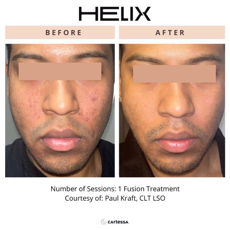 CoolPeel Before & After Image