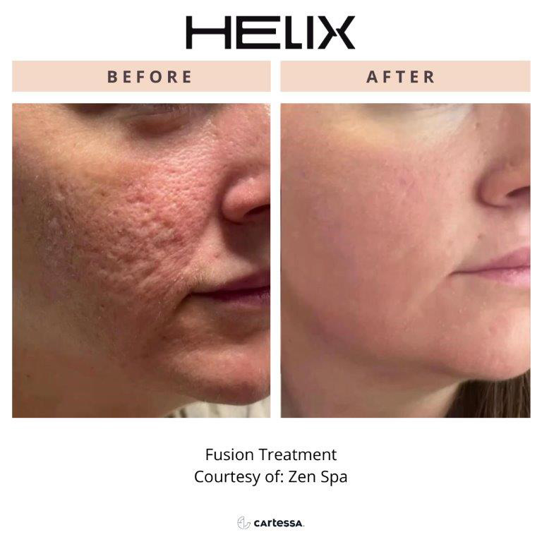 CoolPeel Before & After Image