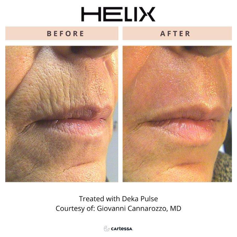 CoolPeel Before & After Image