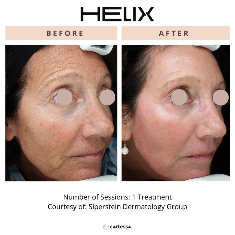 CoolPeel Before & After Image