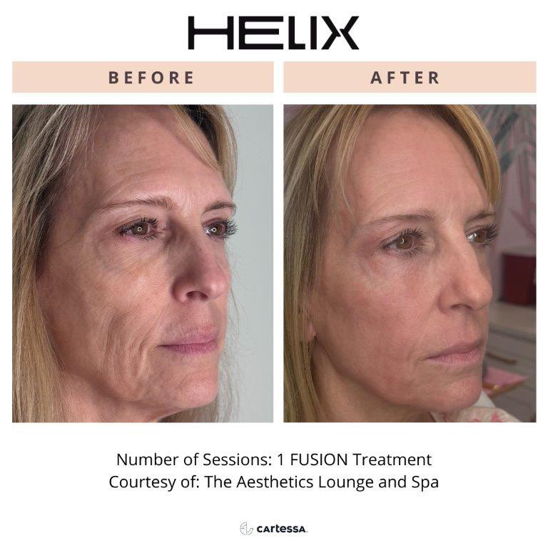 CoolPeel Before & After Image