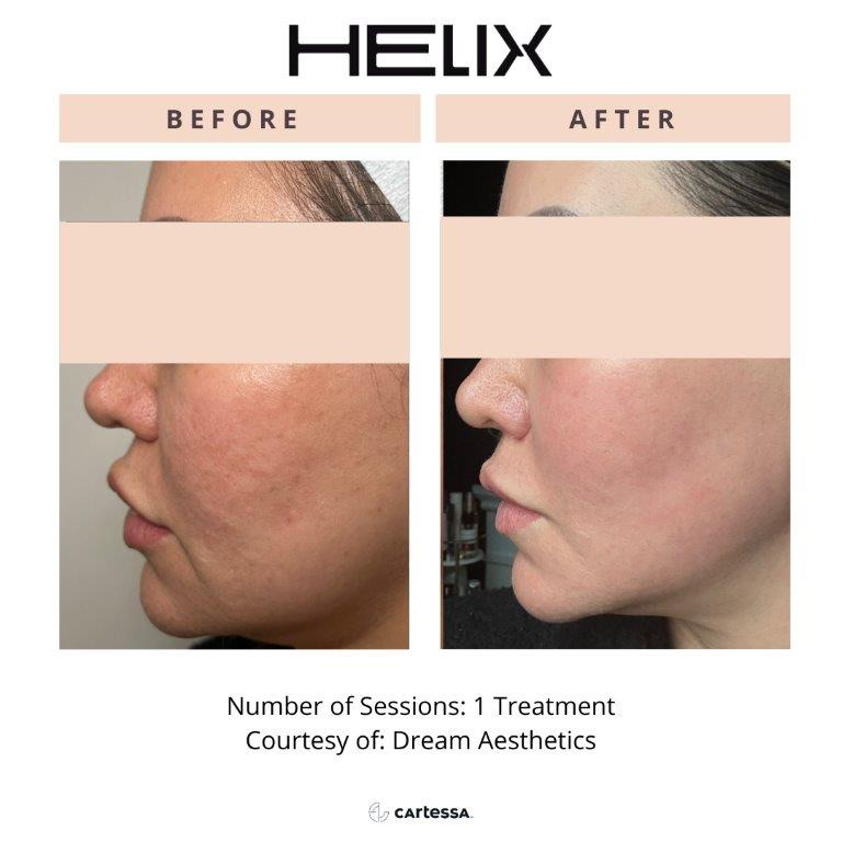 CoolPeel Before & After Image