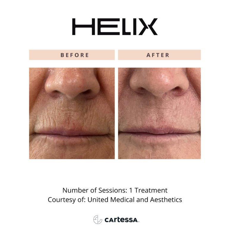 CoolPeel Before & After Image
