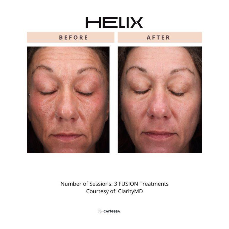 CoolPeel Before & After Image