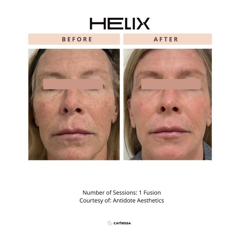 CoolPeel Before & After Image