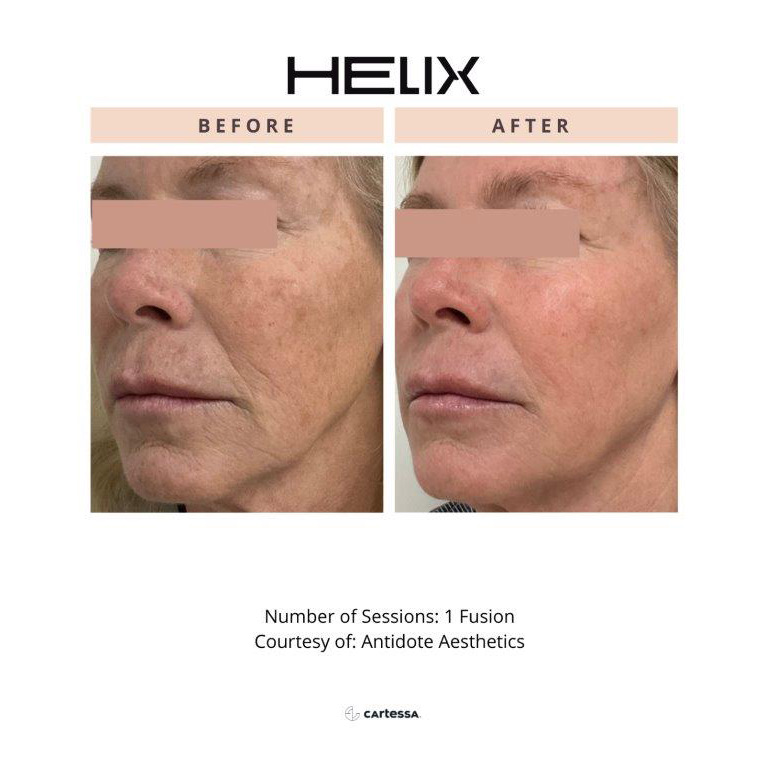 CoolPeel Before & After Image
