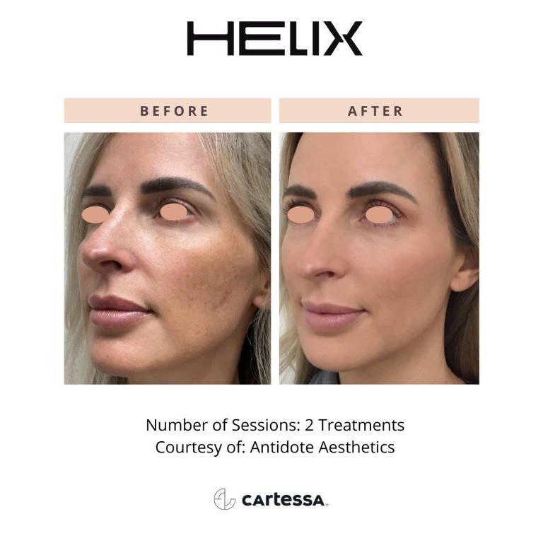 CoolPeel Before & After Image