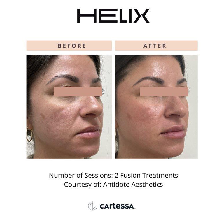 CoolPeel Before & After Image