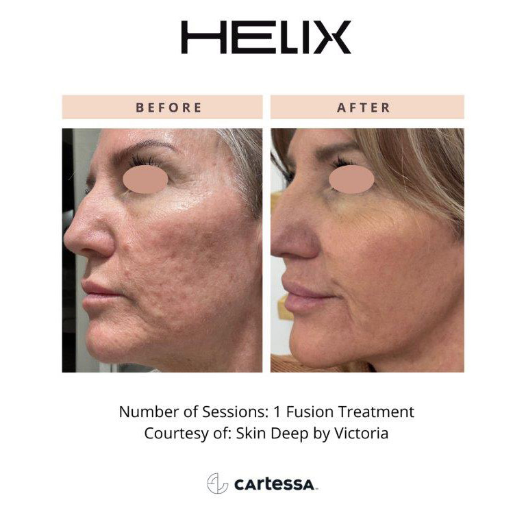 CoolPeel Before & After Image