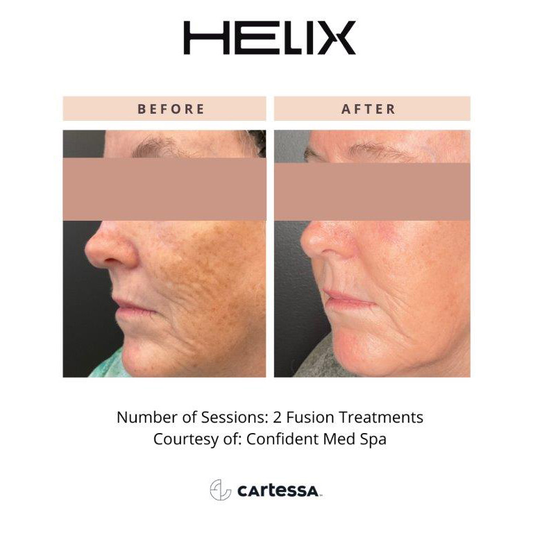 CoolPeel Before & After Image