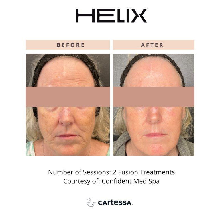 CoolPeel Before & After Image