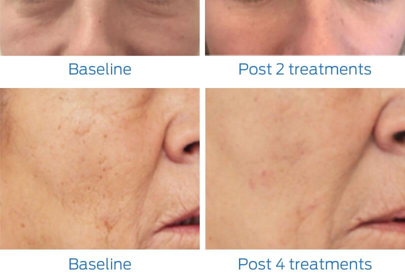 Fraxel Laser Before & After Image