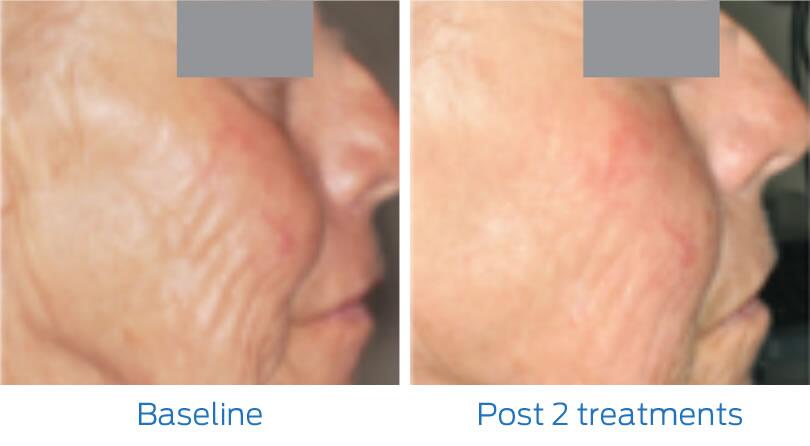 Fraxel Laser Before & After Image