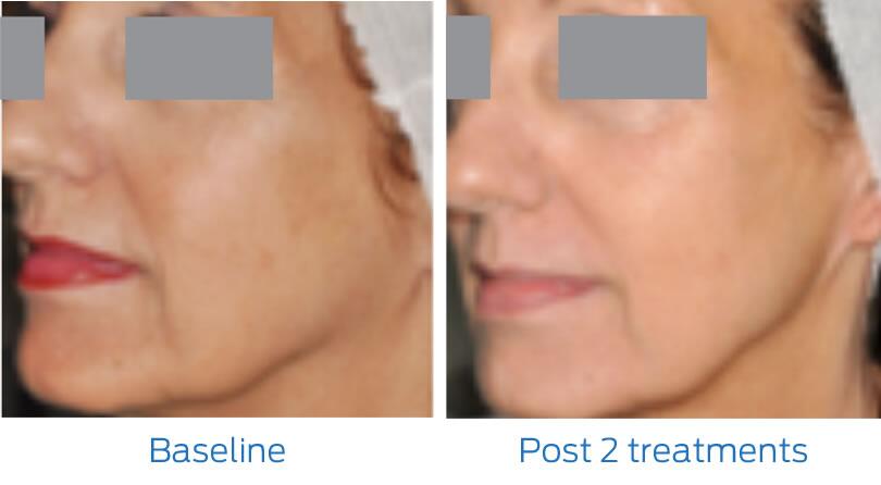 Fraxel Laser Before & After Image