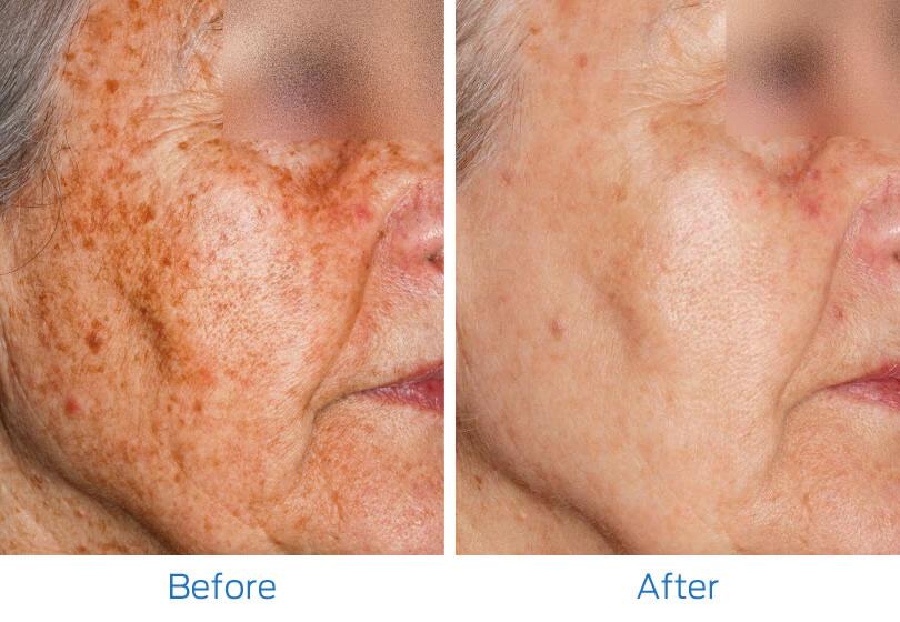 Laser Hyperpigmentation Before & After Image