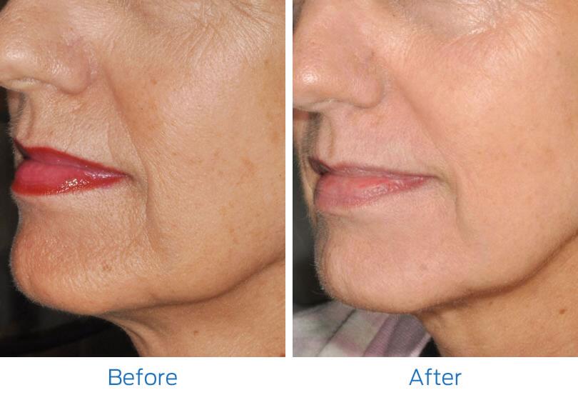 Laser Hyperpigmentation Before & After Image