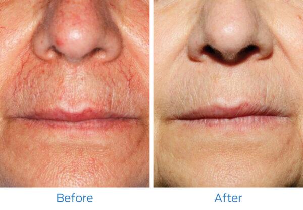 Laser IPL Photofacial Before & After Image