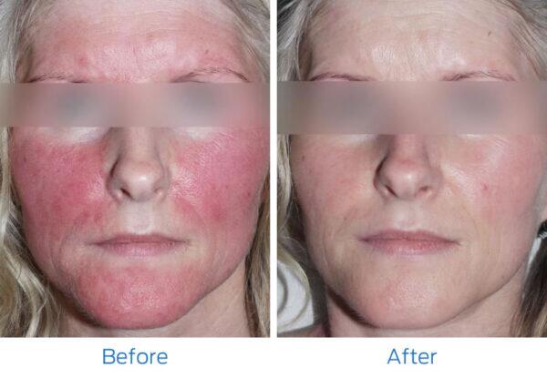 Laser IPL Photofacial Before & After Image