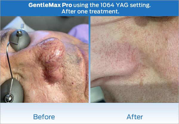 Laser IPL Photofacial Before & After Image