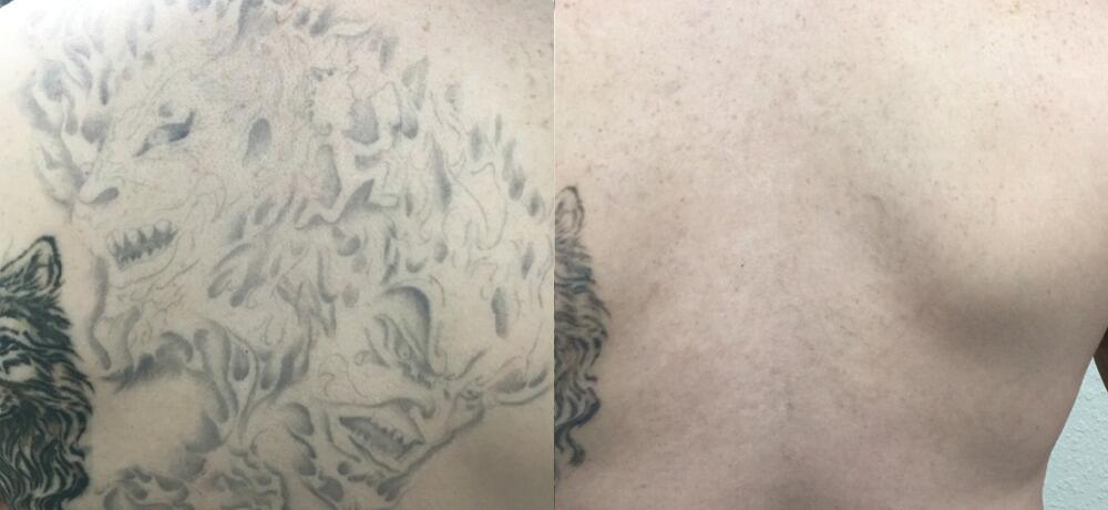 Tattoo Removal Before & After Image