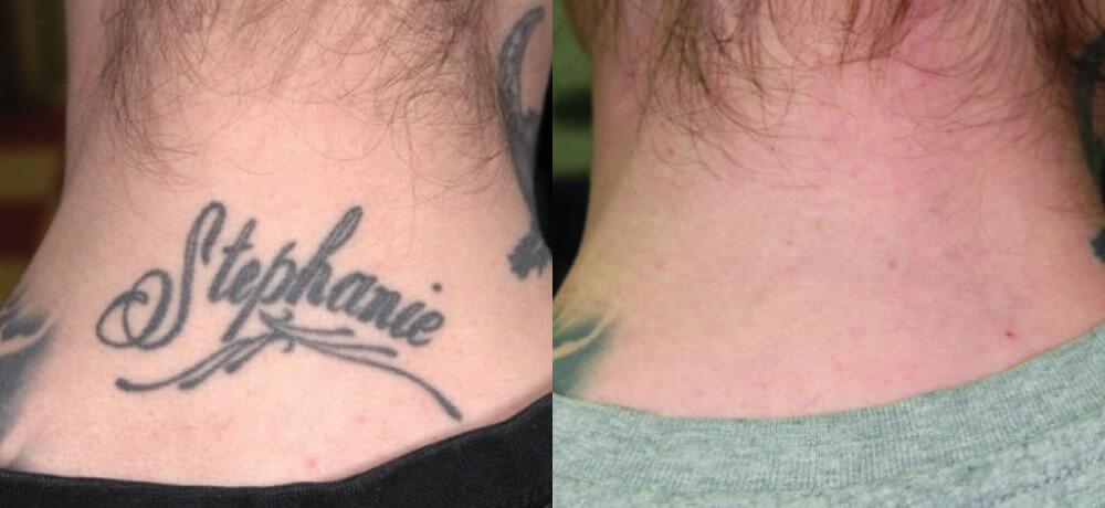 Tattoo Removal Before & After Image