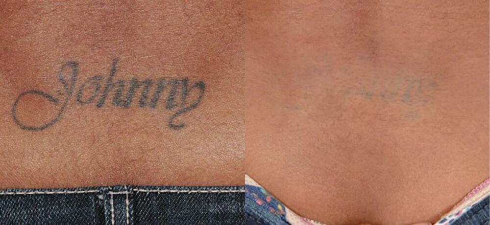 Tattoo Removal Before & After Image