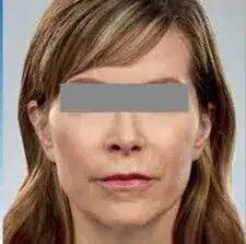 After photo showing a woman’s lower face and cheek area prior to dermal filler treatment