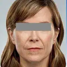 Before photo showing a woman’s lower face and cheek area prior to dermal filler treatment