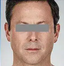 After photo showing a woman’s mid-face and cheek area before dermal filler treatment.