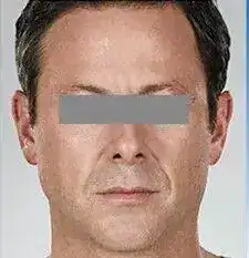 Before photo showing a woman’s mid-face and cheek area before dermal filler treatment.