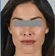 After photo showing a woman’s lower face and jawline prior to dermal filler treatment.