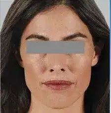 Before photo showing a woman’s lower face and jawline prior to dermal filler treatment.