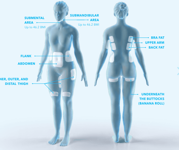 Medical diagram showing various body treatment areas for fat freezing, including the abdomen, flanks, thighs, and submental region.