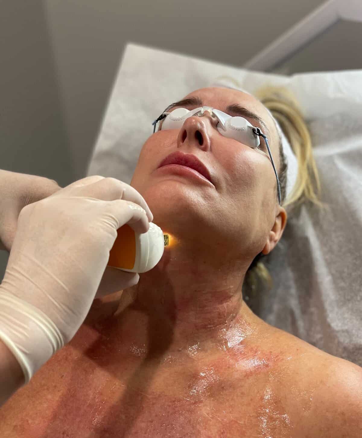 A patient receiving a professional carbon laser peel treatment with a dark facial mask and protective eye shields.