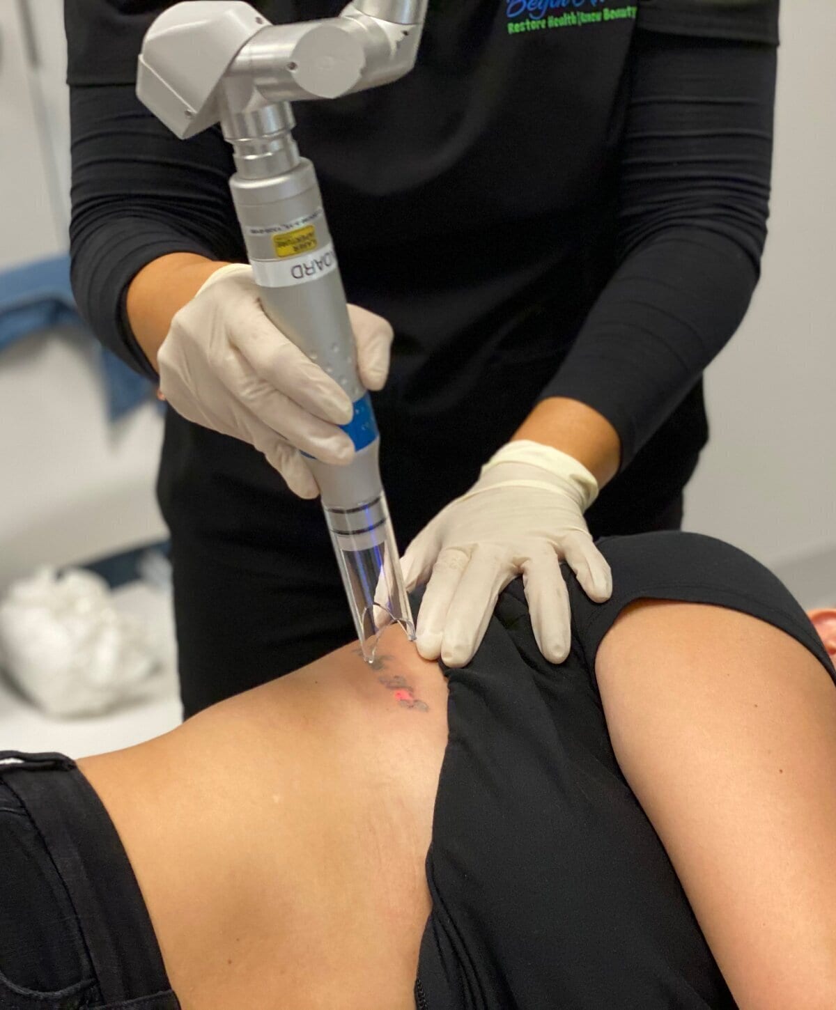 Professional laser technician performing a laser tattoo removal treatment on a patient's lower back.