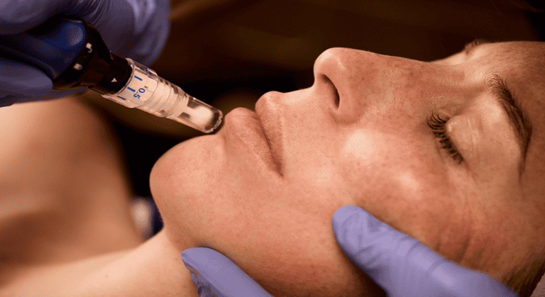 SkinPen® Precision Elite: The Gold Standard in Microneedling