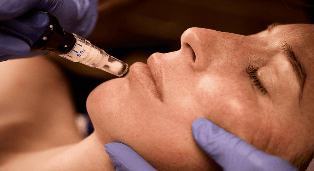 SkinPen® Precision Elite: The Gold Standard in Microneedling